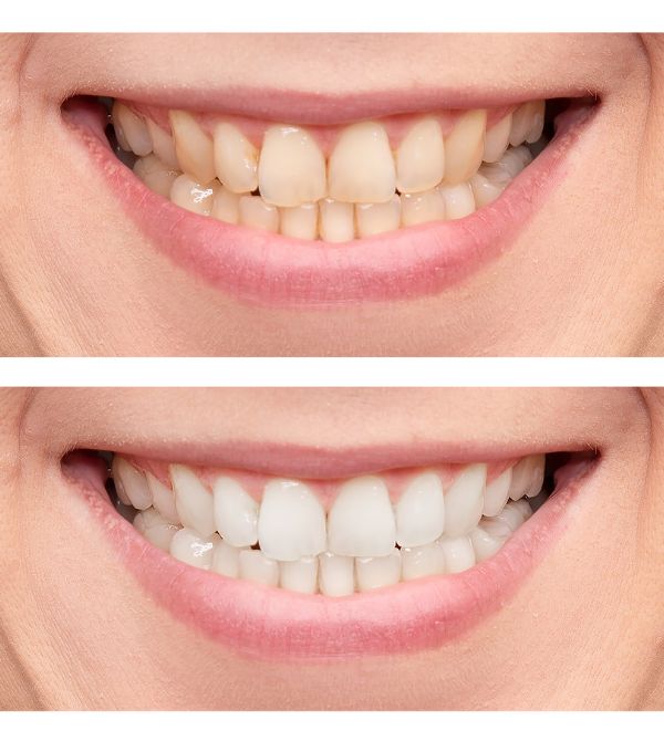How Is Teeth Whitening Done? All You Need To Know